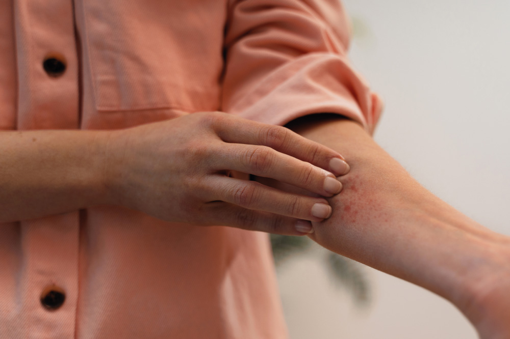 DERMATITE ATOPICA: ANCHE LA DIETA È CHIAMATA IN CAUSA?